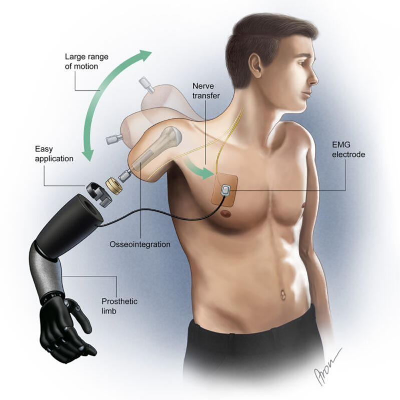TMR Arm device TMR Arm device